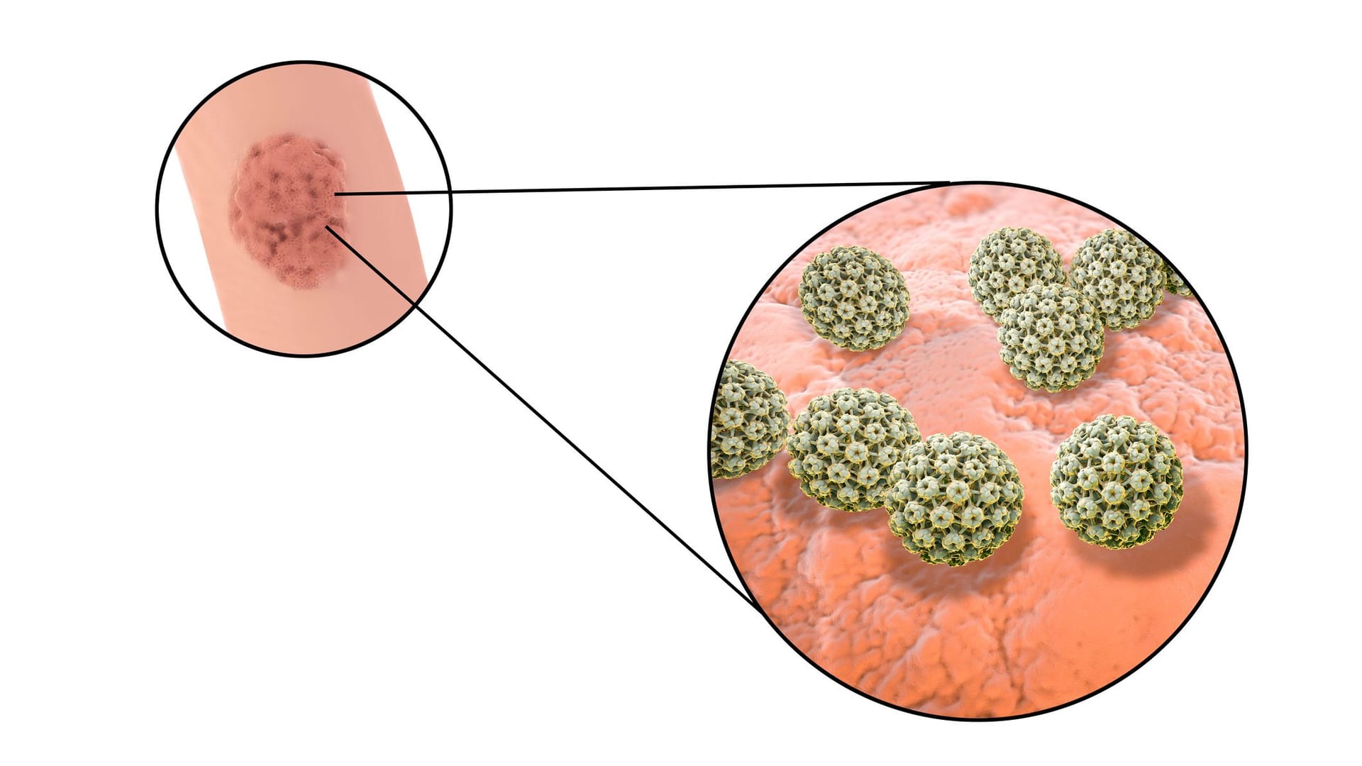 Illustration: Warze und humane Papillomaviren.