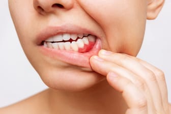 Frühzeitig Handeln: Gerötetes Zahnfleisch und Zahnfleischbluten können Anzeichen für eine Parodontitis sein.