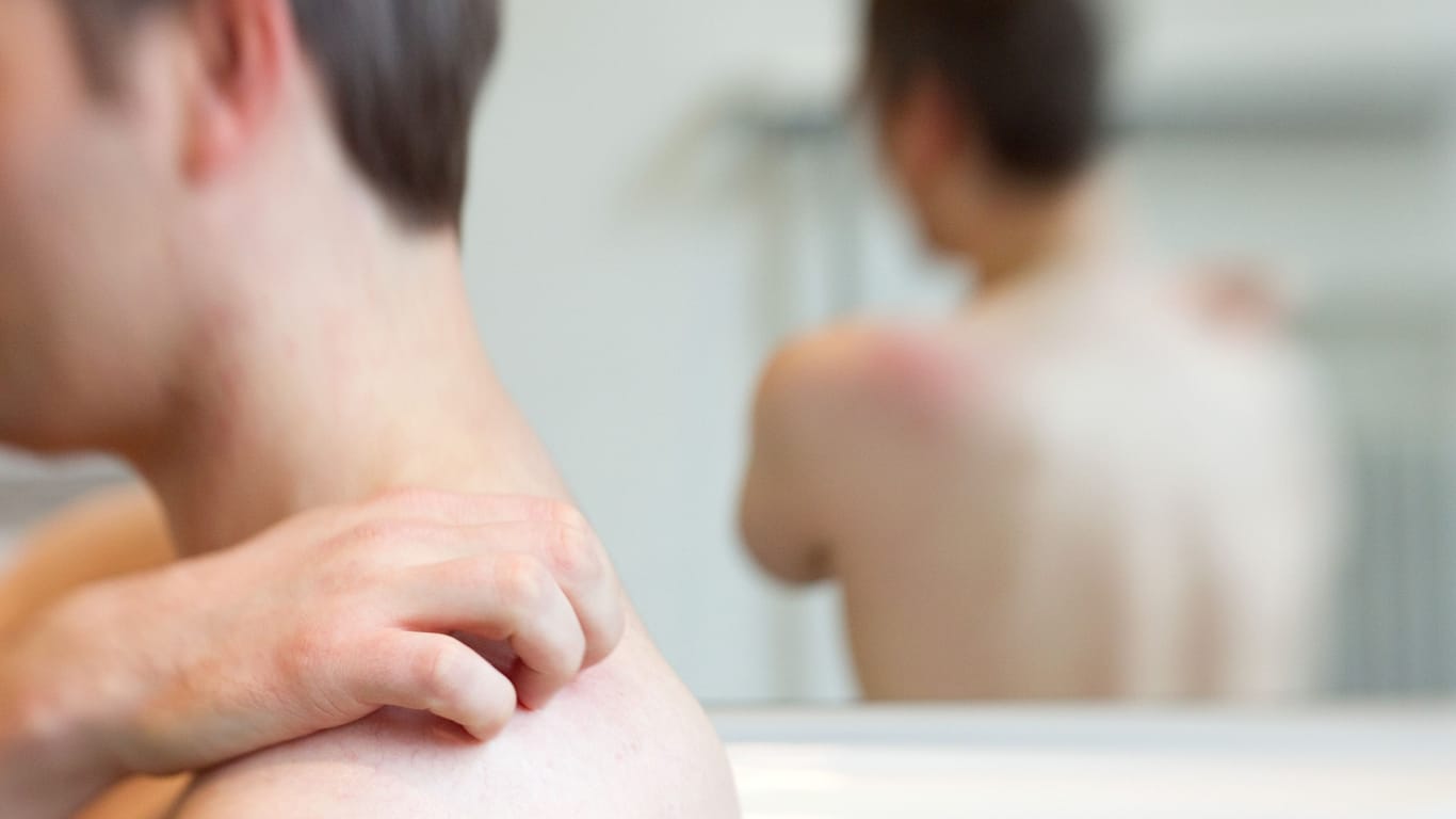 Schmerzhafter Ausschlag: Hautbläschen und Juckreiz sind typische Symptome der Gürtelrose.