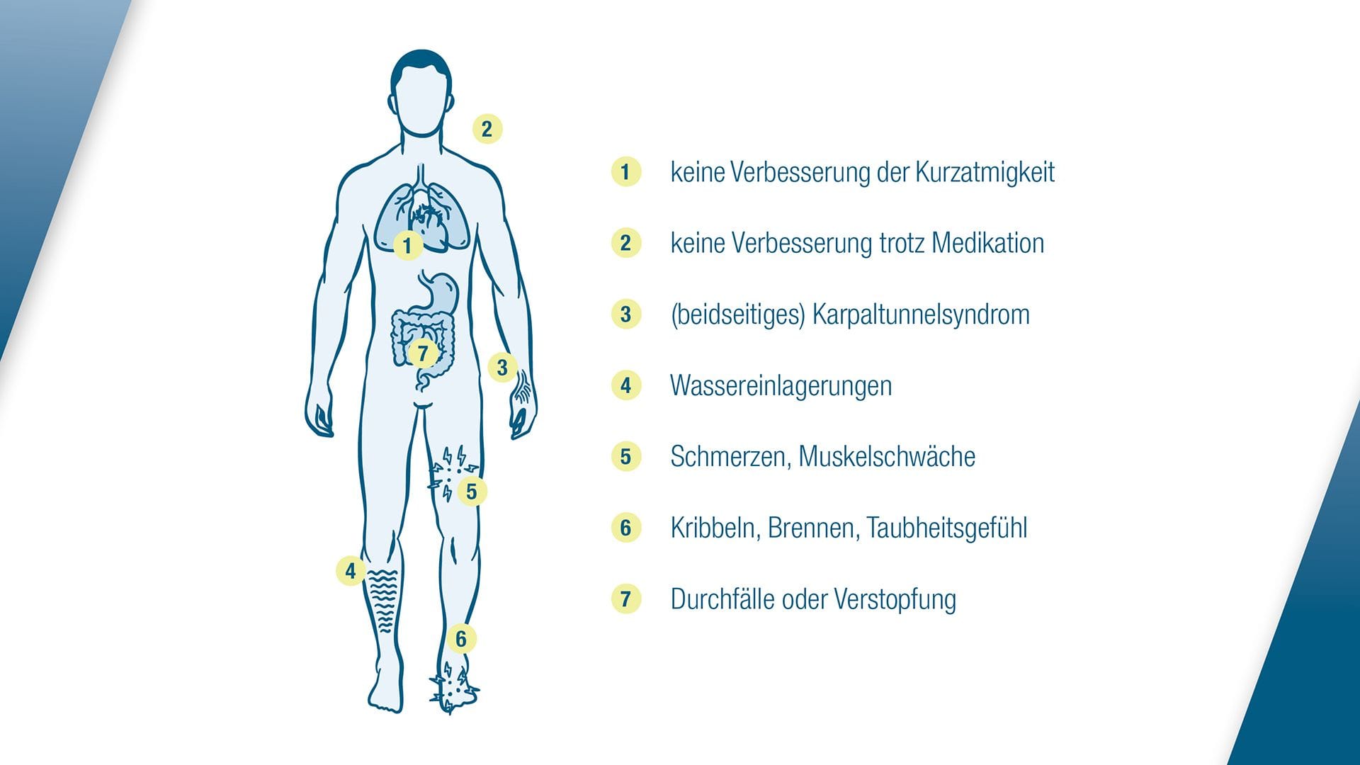 Typische Anzeichen einer Herzschwäche, ein Karpaltunnelsyndrom und Wassereinlagerungen können auf eine ATTR-CM hindeuten. Typische Anzeichen einer Herzschwäche, ein Karpaltunnelsyndrom und Wassereinlagerungen können auf eine ATTR-CM hindeuten.