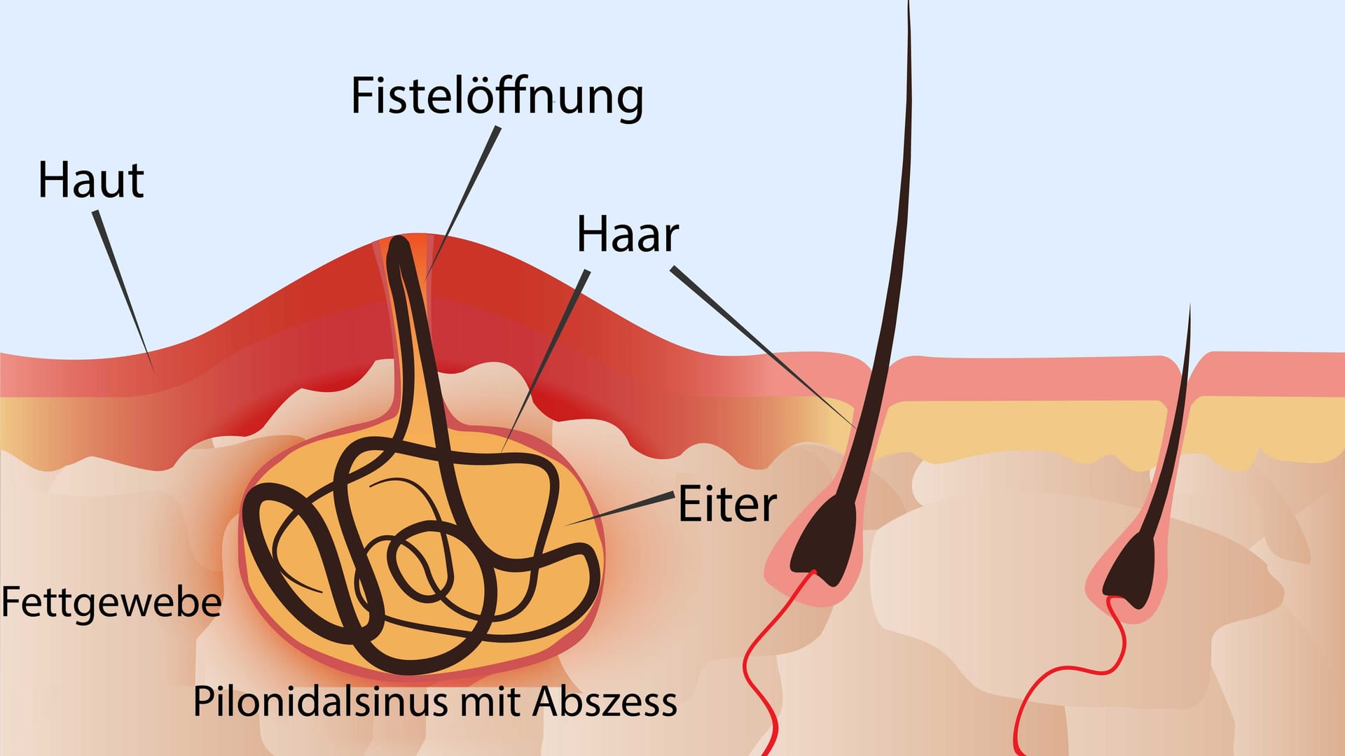 Bei einem akuten Pilonidalsinus hat sich eine Eiteransammlung (Abszess) entwickelt, die Haut ist entzündlich geschwollen und gerötet.