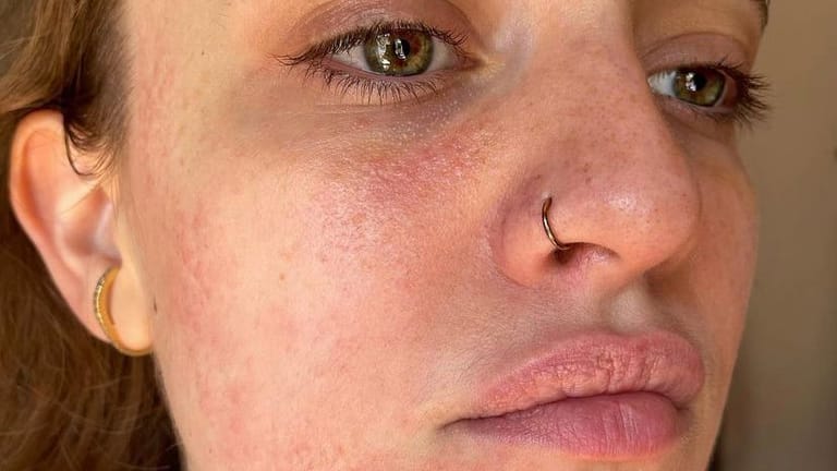 Mit diesem Foto zeigt Felicia Binger auf Instagram die Nesselsucht, die sie kurz nach ihrer Impfung bekam.