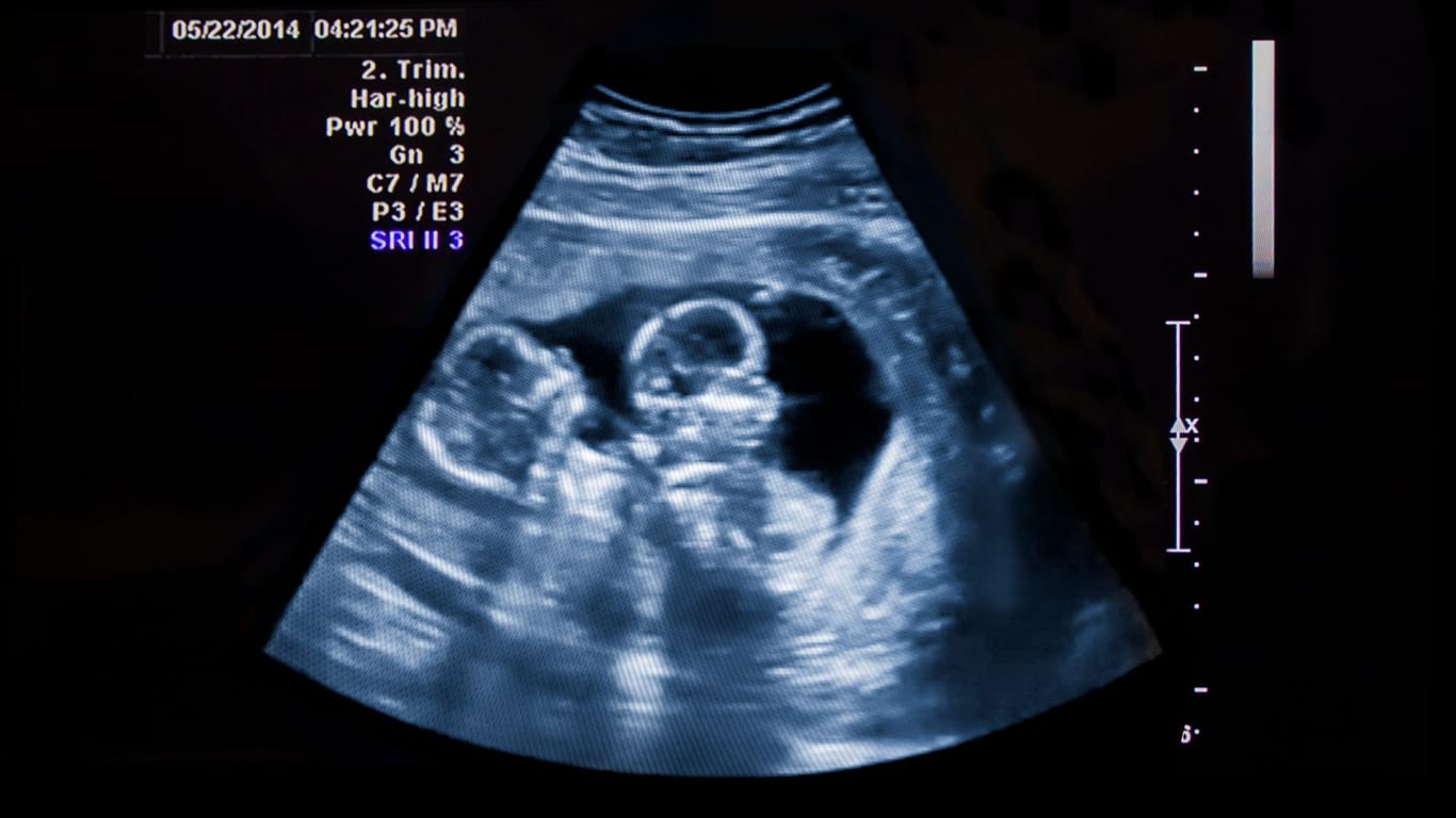 Ultraschall von Zwillingen: Auch Kinderwunschbehandlungen erhöhen die Wahrscheinlichkeit für Zwillinge.