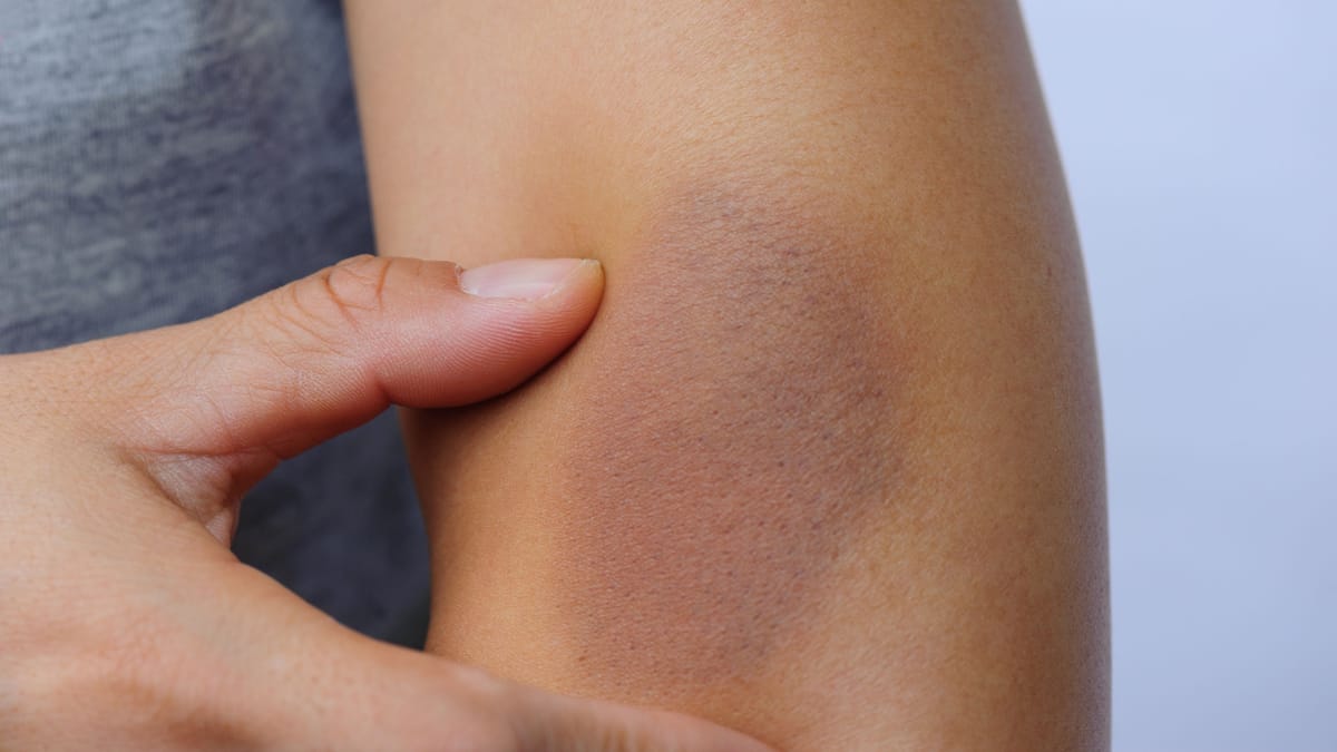 Leukämie: Häufige blaue Flecken können Anzeichen sein