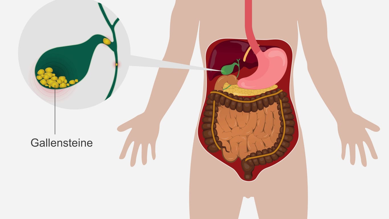 Illustration: Gallensteine und Lage der Gallenblase im Körper