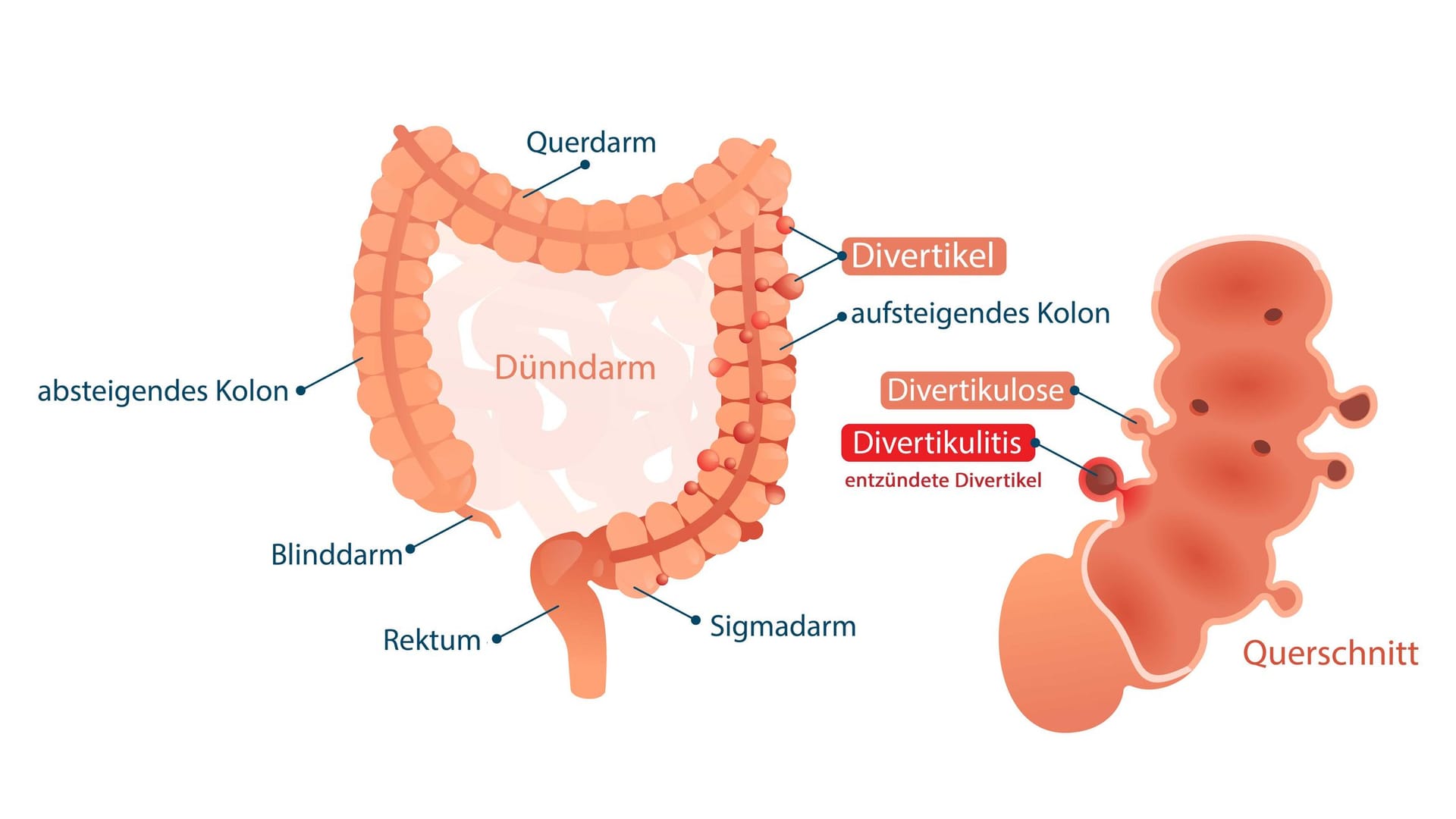 Illustration Divertikulitis
