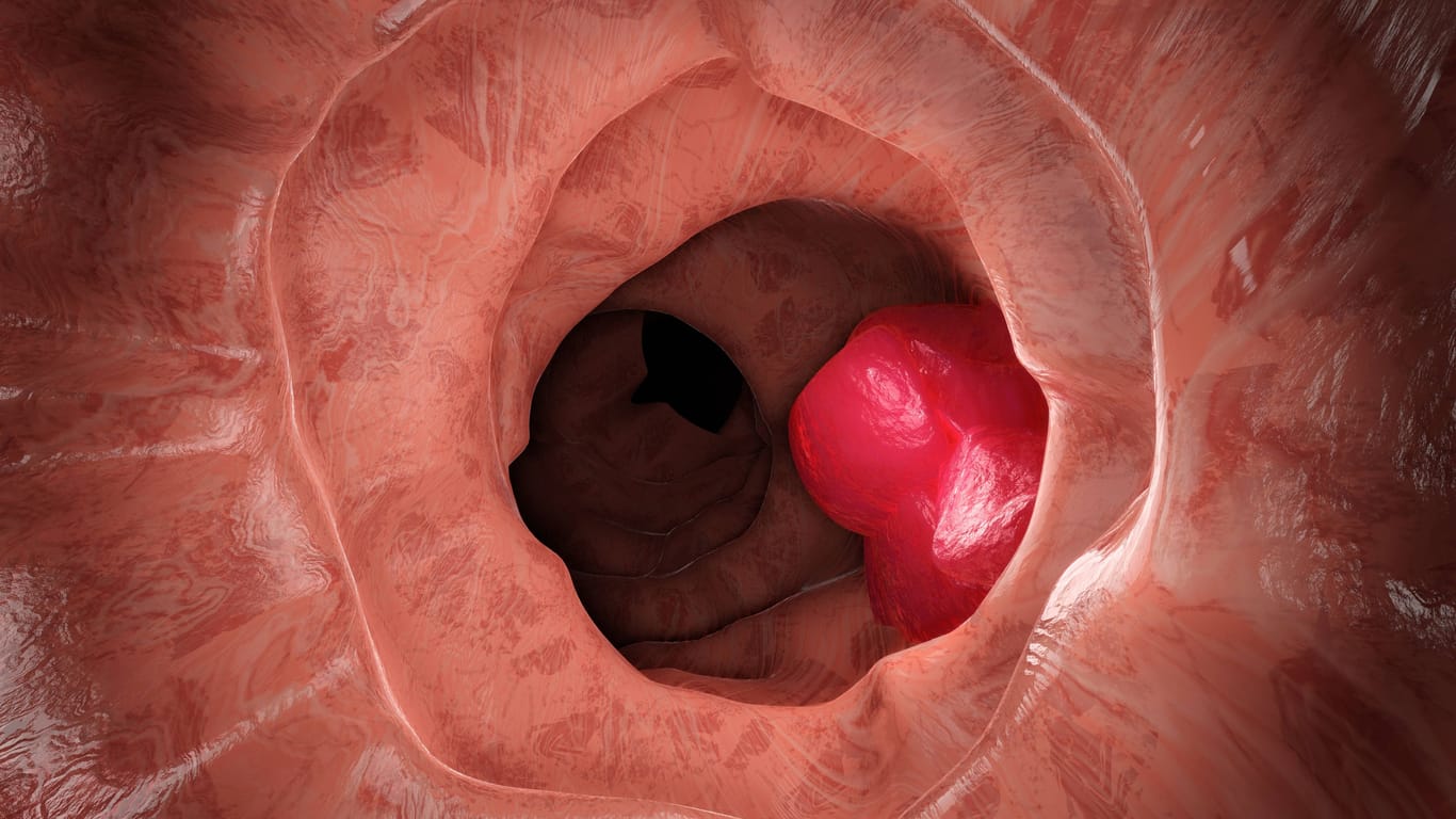Blick in den Darm: Krebszellen im Darm lassen sich nur mit einer Endoskopie feststellen.