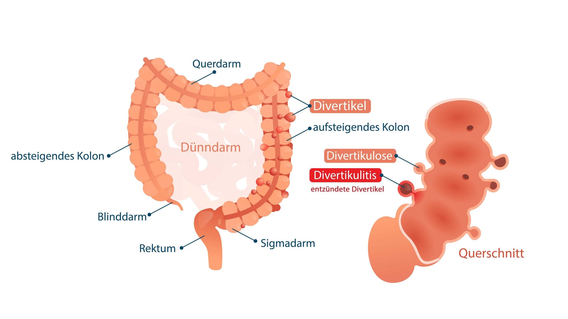 Illustration Divertikulitis