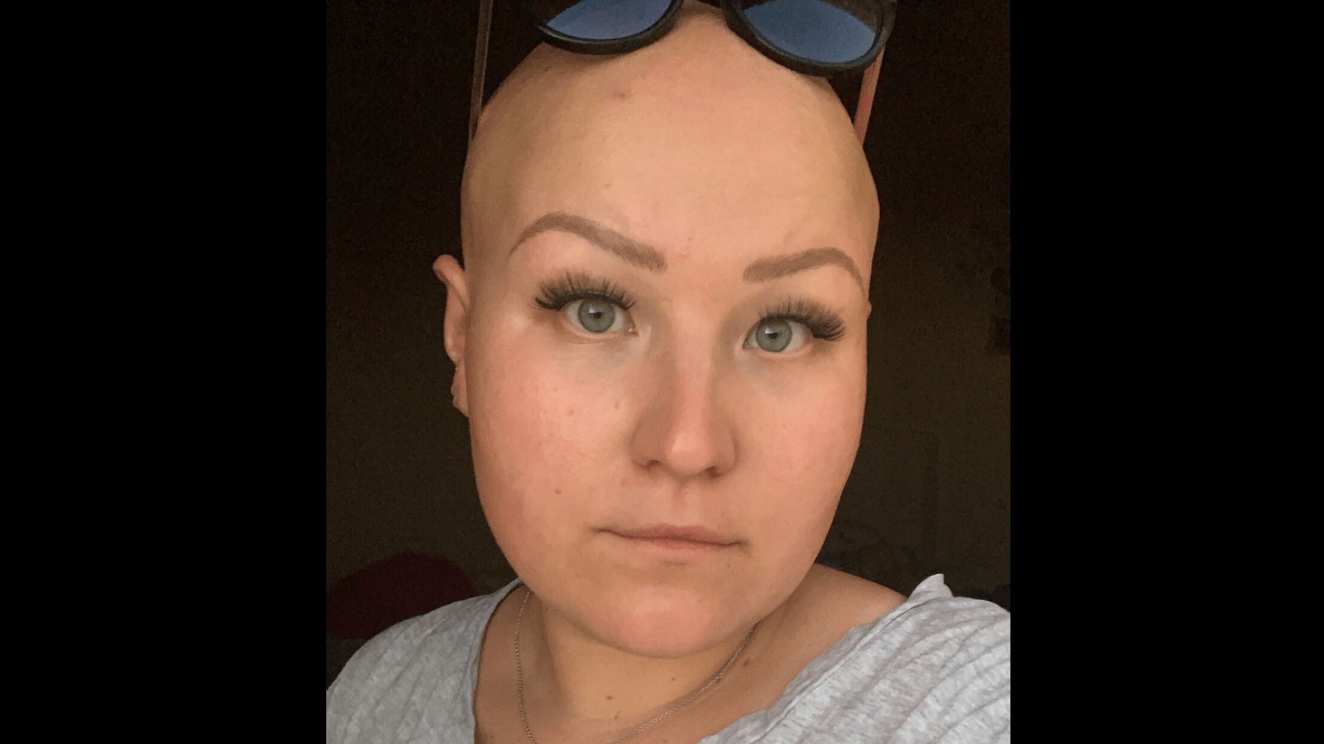 Lena Kläsgen hat die Autoimmunkrankheit Alopecia Areata und konnte sich daher nicht impfen lassen.