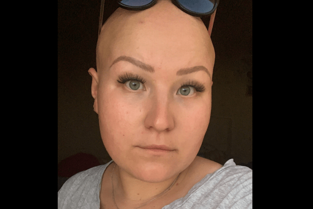 Lena Kläsgen hat die Autoimmunkrankheit Alopecia Areata und konnte sich daher nicht impfen lassen.