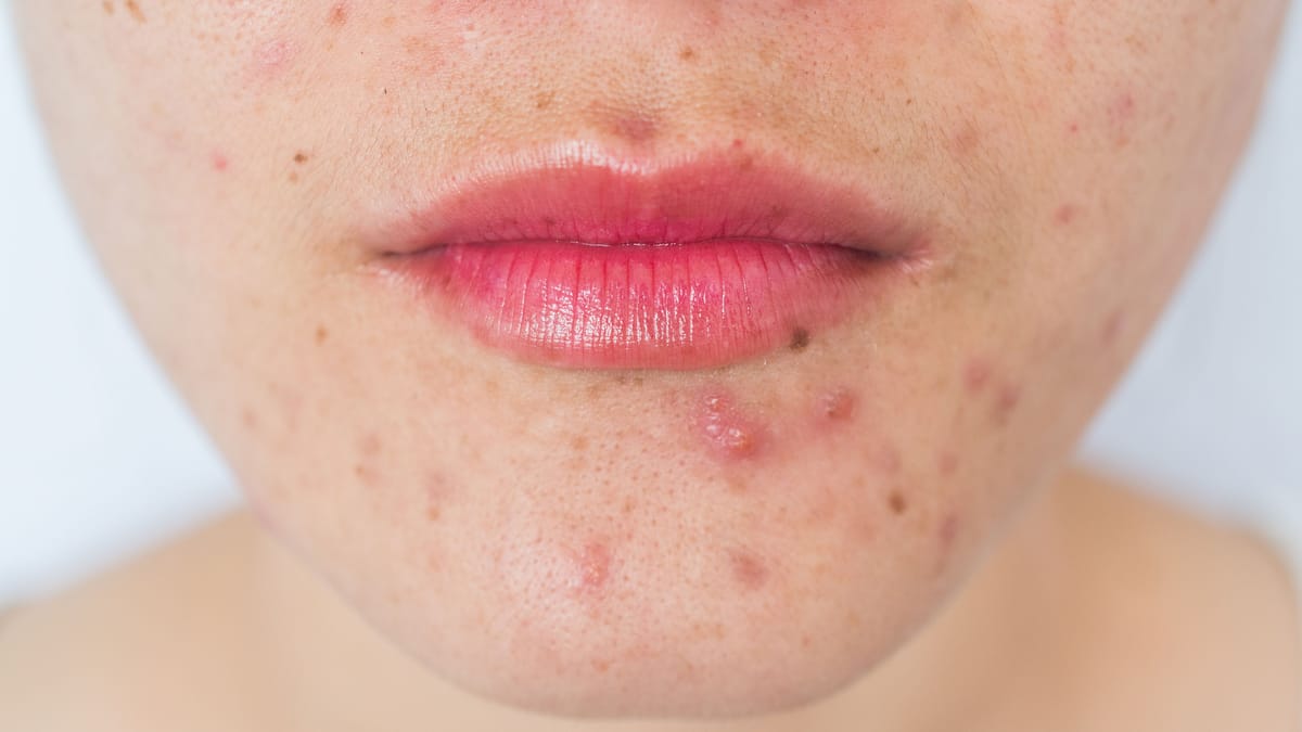 Lippenherpes oder Pickel? Unterschiede frühzeitig erkennen