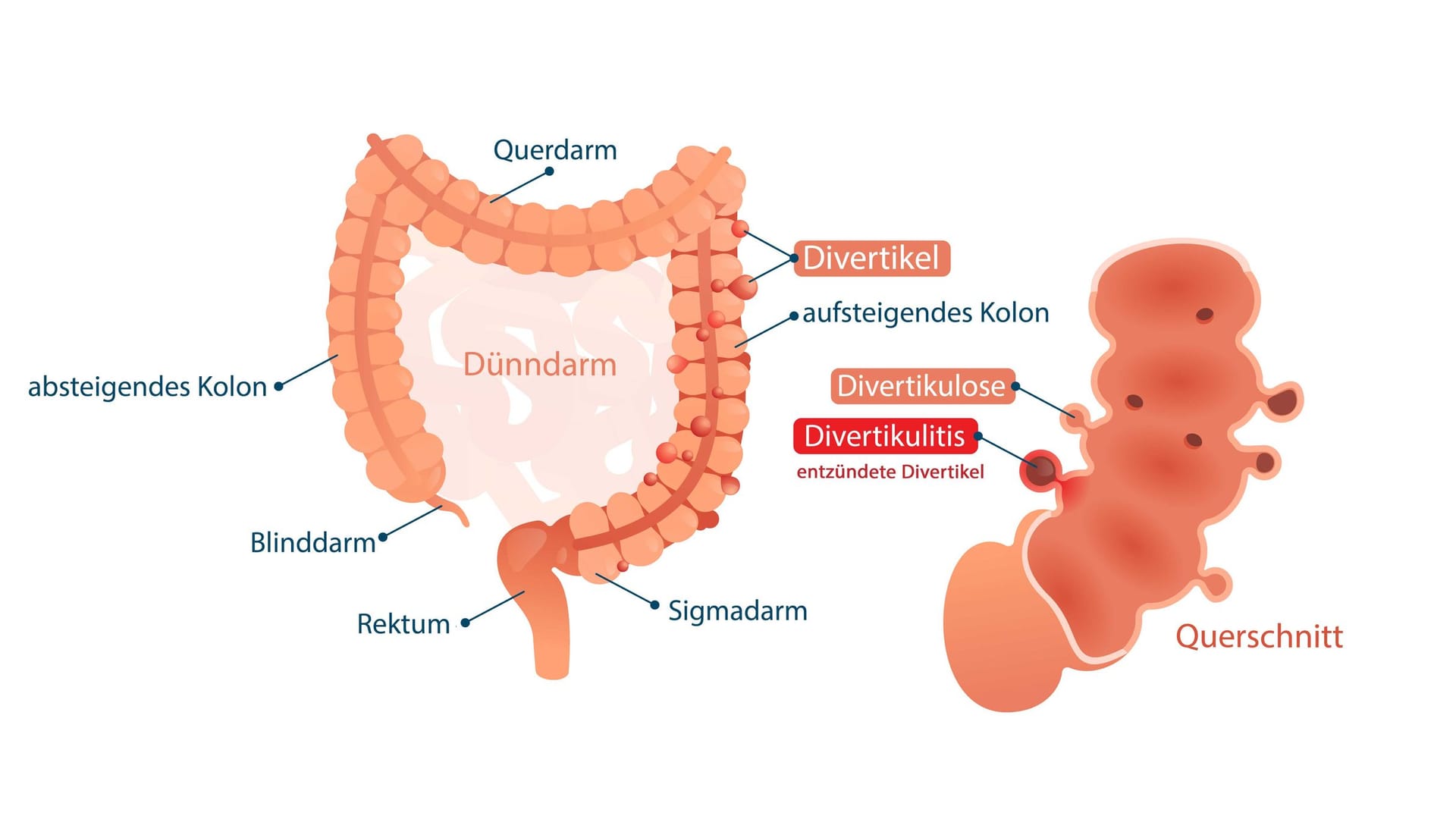 Illustration Divertikulitis
