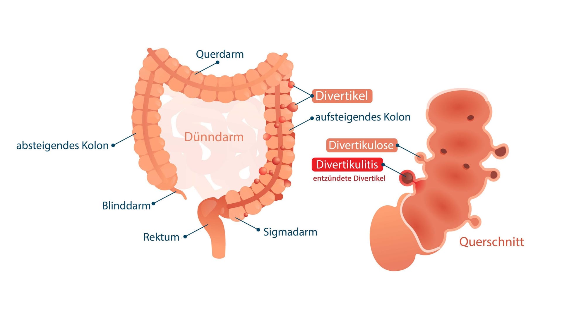 Illustration Divertikulitis