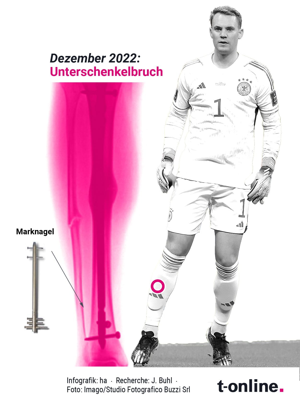 Manuel Neuer: Bei einem Unterschenkelbruch, wie ihn der Torhüter des FC Bayern erlitten hat, ist das Einsetzen eines sogenannten Marknagels in den Knochen ein in der Orthopädie gängiges Verfahren.