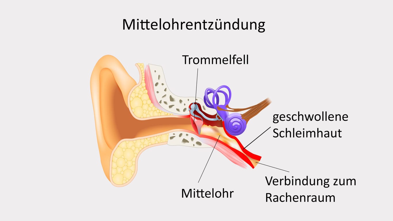 Illustration: Entzündung des Mittelohrs