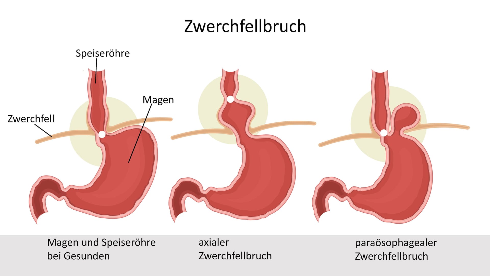 Illustration: Formen von Zwerchfellbruch