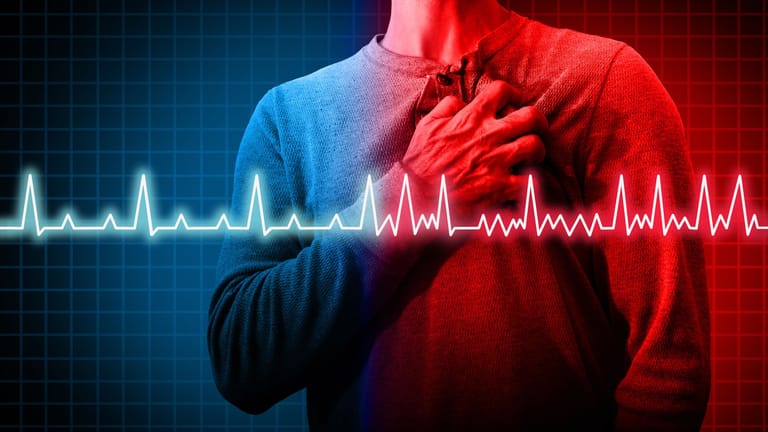 Bei einem Vorhofflimmern breiten sich elektrische Impulse in den Vorhöfen des Herzens unregelmäßig aus. Die Herzkammern pumpen zwar weiter Blut in den Körper, allerdings weniger und unregelmäßiger.