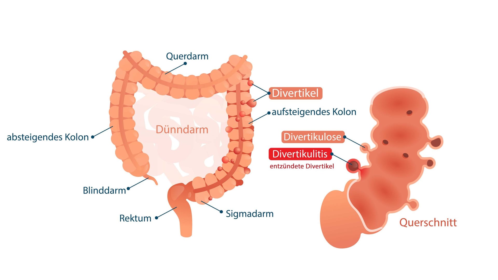 Illustration Divertikulose/Divertikulitis