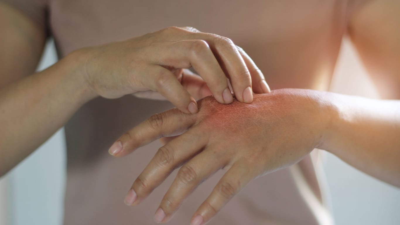 Eine Frau berührt die gerötete Haut auf ihrem Handrücken.