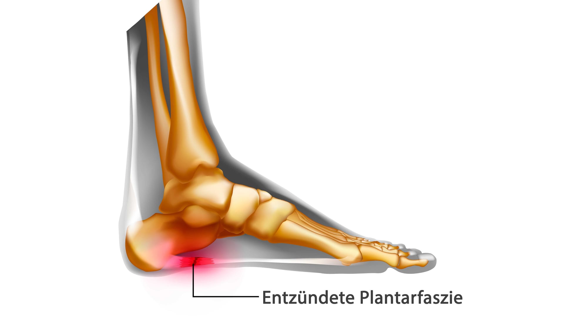 Illustration Plantarfasziitis: Ist der Sehnenansatz der Plantarfaszie am Fersenbein entzündet, liegt eine Plantarfasziitis vor.