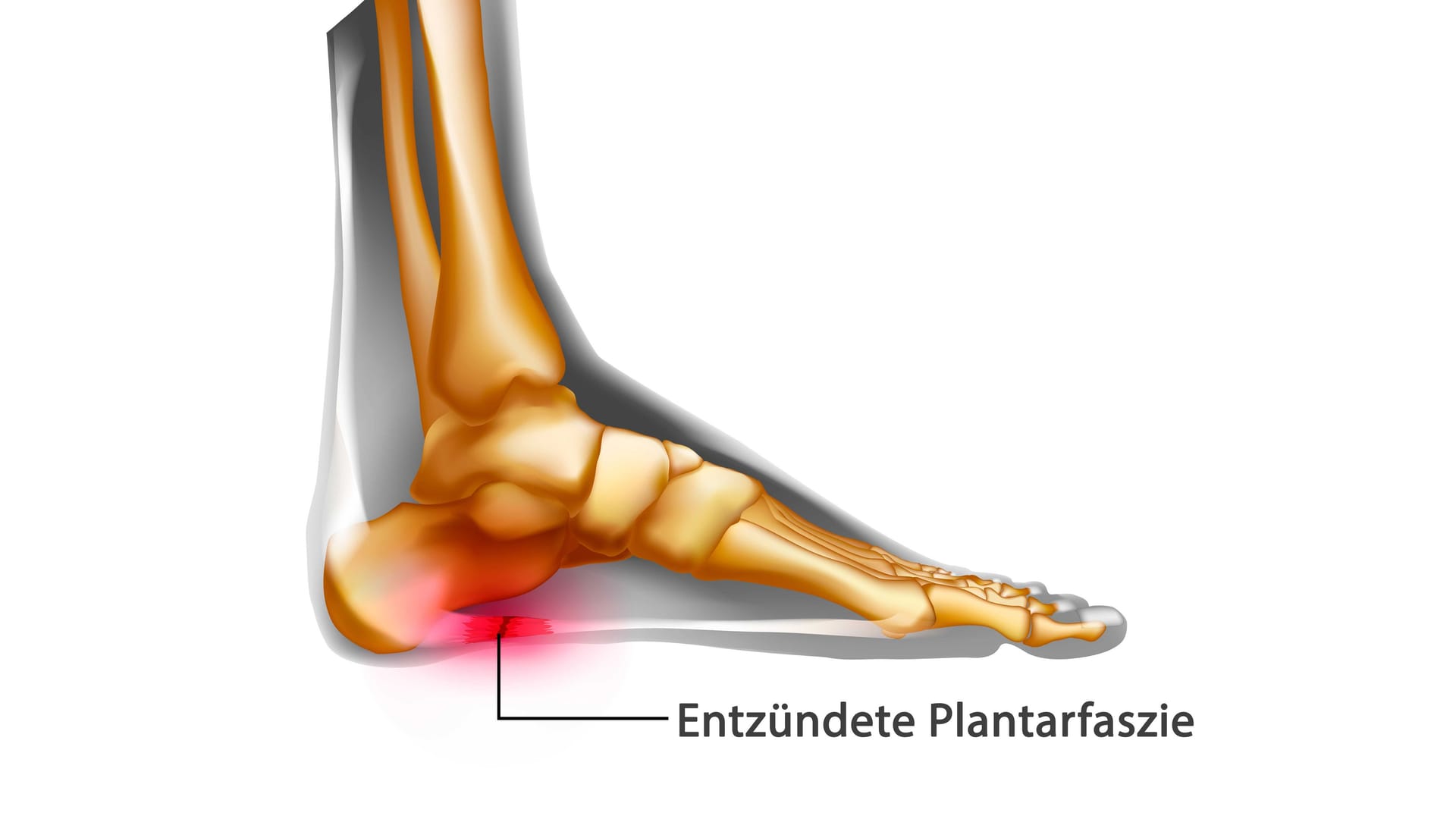 Illustration Plantarfasziitis: Ist der Sehnenansatz der Plantarfaszie am Fersenbein entzündet, liegt eine Plantarfasziitis vor.