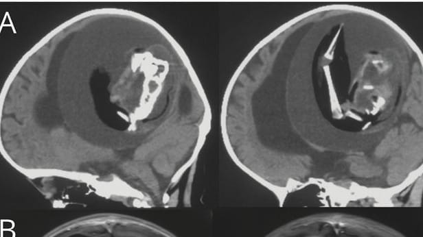 Bilder des "Fötus-in-Fötu": Eine Einjährige hatte einen Fötus in ihrem Gehirn.