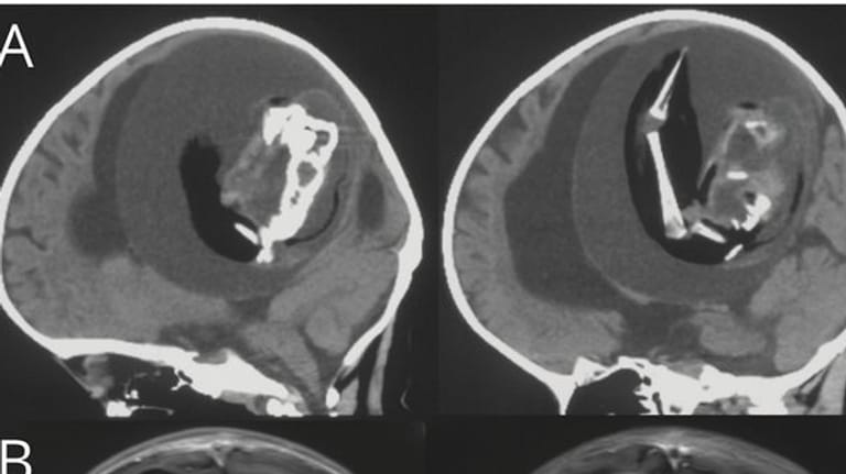 Bilder des "Fötus-in-Fötu": Eine Einjährige hatte einen Fötus in ihrem Gehirn.