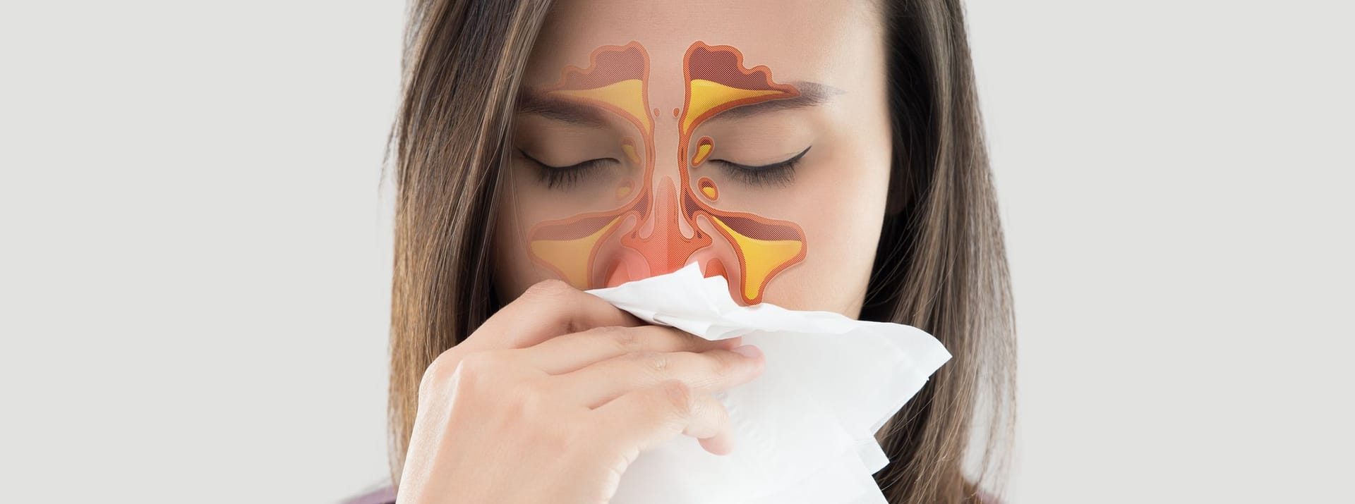 Bei einer Nasennebenhöhlenentzündung ("Sinusitis") sind die Schleimhäute entzündet, welche zu den Nasennebenhöhlen zählen. Dazu gehören die Stirnhöhlen, die Siebbeinzellen und die Keilbein- und Kieferhöhlen. Sie sind für die Bildung der Flüssigkeit zuständig, welche über Nase und Rachen abfließt.