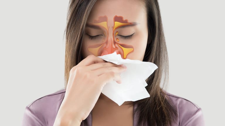 Bei einer Nasennebenhöhlenentzündung ("Sinusitis") sind die Schleimhäute entzündet, welche zu den Nasennebenhöhlen zählen. Dazu gehören die Stirnhöhlen, die Siebbeinzellen und die Keilbein- und Kieferhöhlen. Sie sind für die Bildung der Flüssigkeit zuständig, welche über Nase und Rachen abfließt.