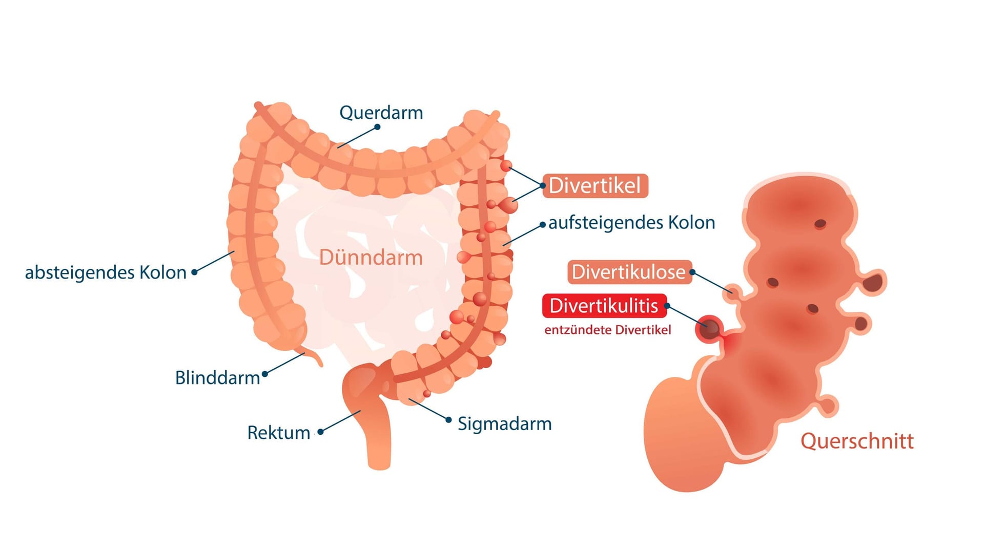 Illustration Divertikulose, Divertikulitis: Entzünden sich Divertikel im Dickdarm, handelt es sich um eine Divertikulitis.