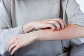 Eine Frau kratzt sich an einer geröteten Stelle am Unterarm: Je nachdem, um welche Form der Porphyrie es sich handelt, kann es auch zu Hautausschlag kommen.