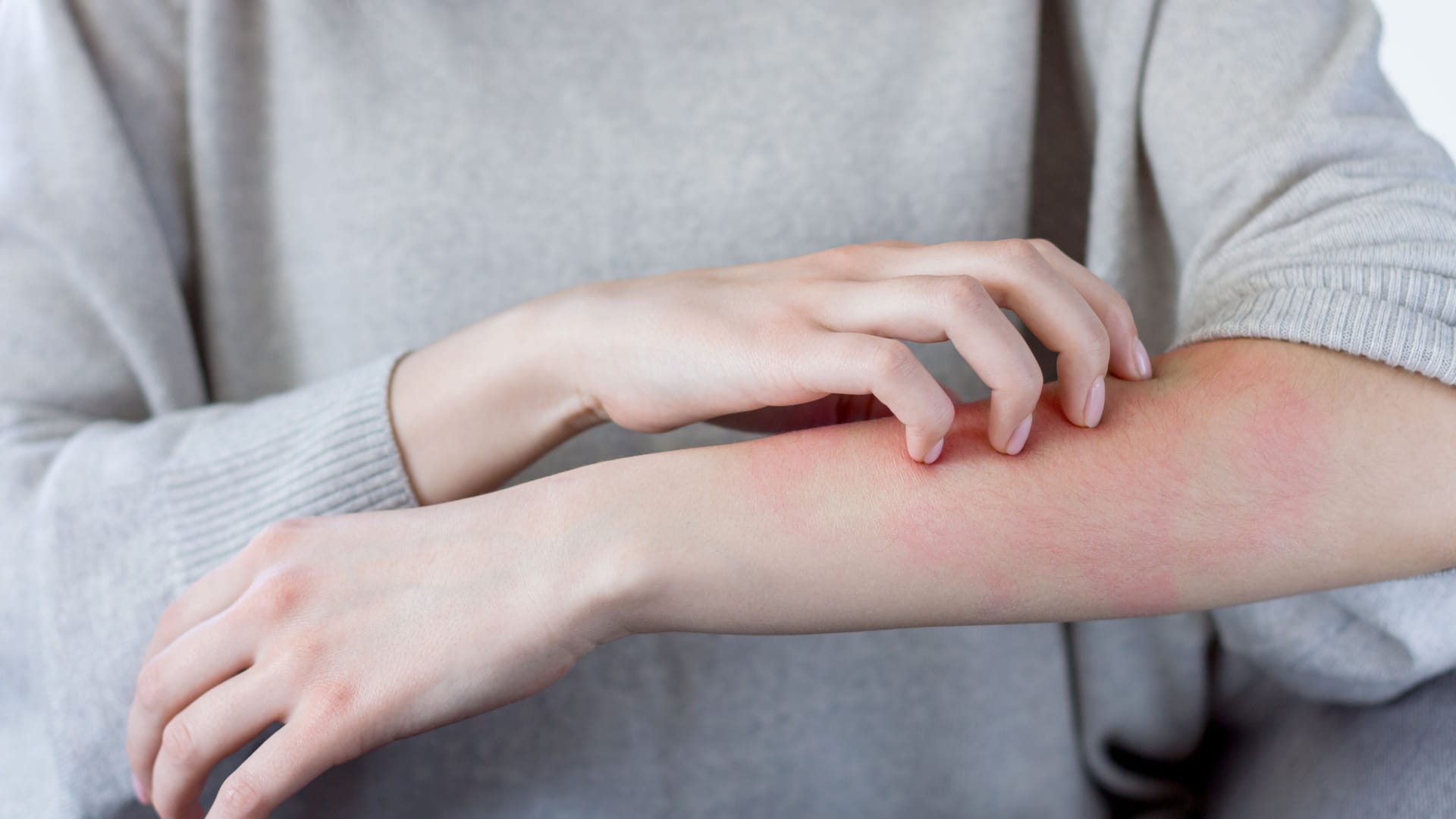 Eine Frau kratzt sich an einer geröteten Stelle am Unterarm: Je nachdem, um welche Form der Porphyrie es sich handelt, kann es auch zu Hautausschlag kommen.