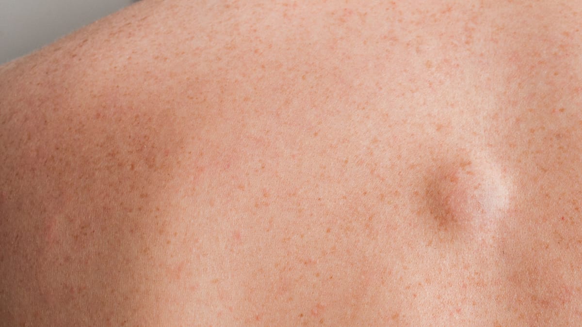 Lipom am Rücken – was das ist und wie es sich entfernen lässt