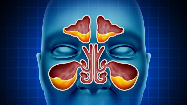 Bei einer Sinusitis sammelt sich Sekret in den Nasennebenhöhlen und kann nicht über die Nase abfließen. Es kommt zu Entzündungen.