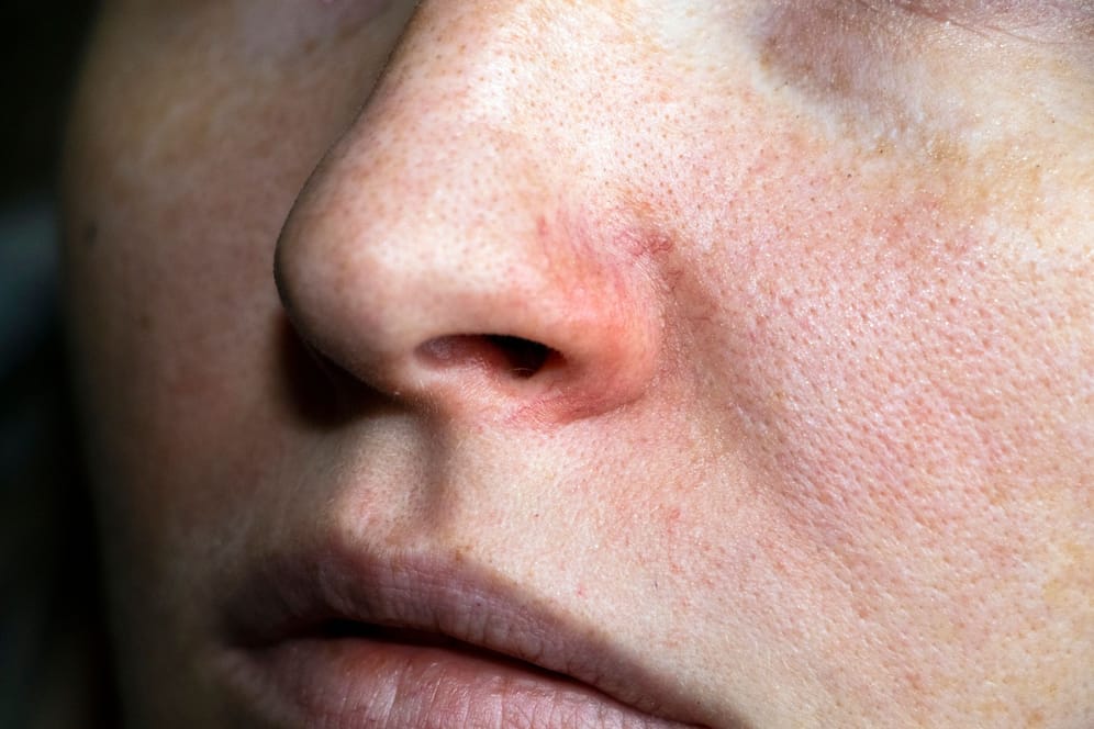 ﻿Anhaltende Entzündungsprozesse bewirken, dass die Hautveränderungen, wie Rötungen oder Äderchen auftreten.