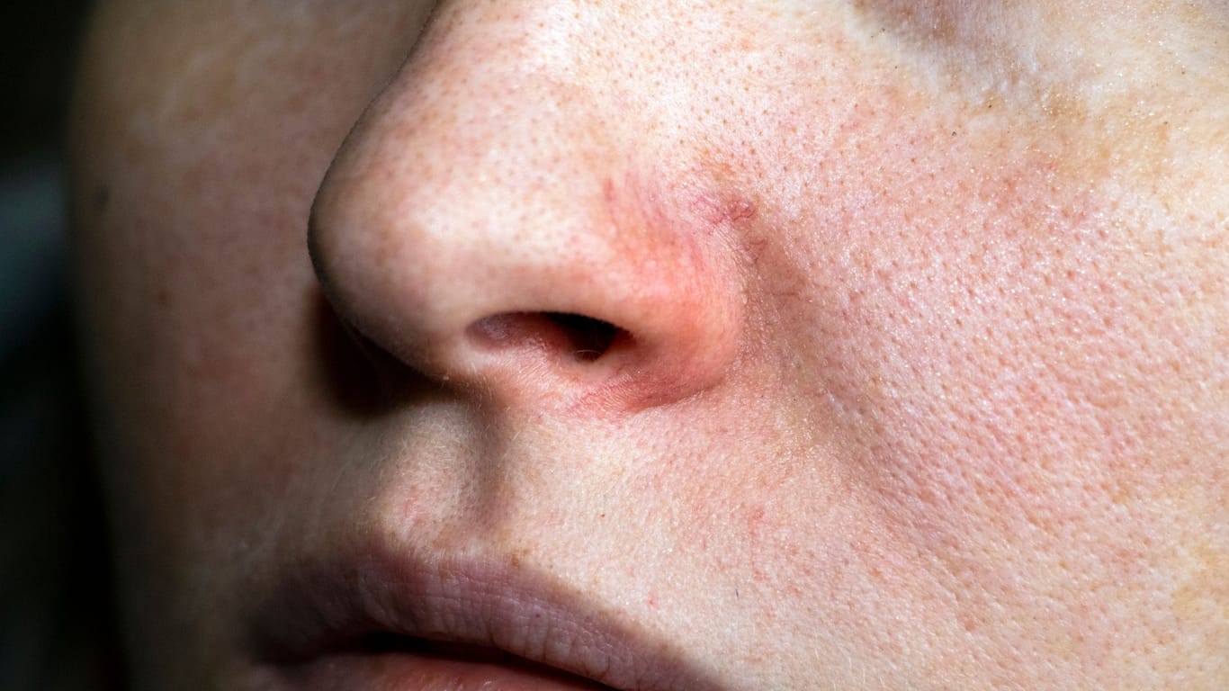 Anhaltende Entzündungsprozesse bewirken, dass die Hautveränderungen, wie Rötungen oder Äderchen auftreten.