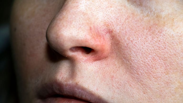 ﻿Anhaltende Entzündungsprozesse bewirken, dass die Hautveränderungen, wie Rötungen oder Äderchen auftreten.