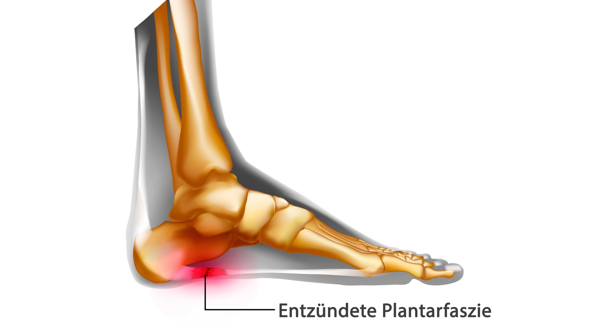 Illustration Plantarfasziitis: Ist die Plantarfaszie entzündet, liegt eine Plantarfasziitis vor.