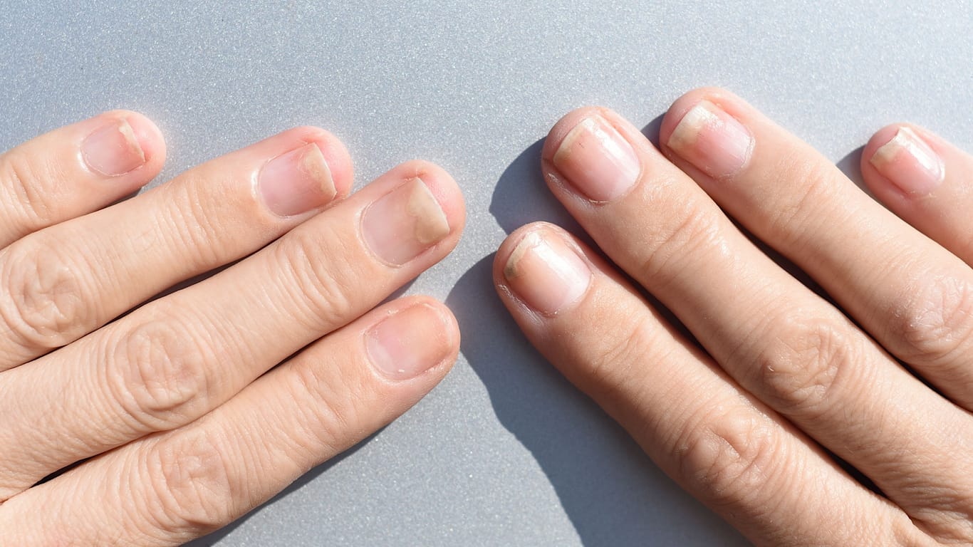 1339169405Wenn sich Fingernägel ablösen, ist die Ursache oft nicht sofort erkennbar.