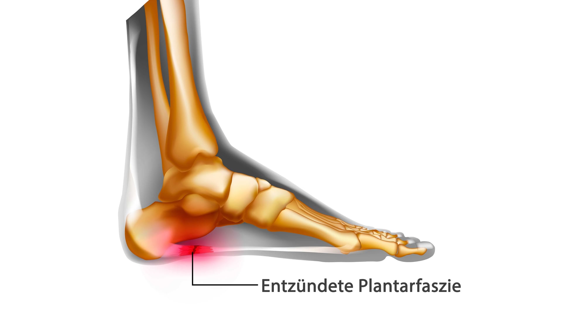 Illustration Plantarfasziitis: Ist der Sehnenansatz der Plantarfaszie am Fersenbein entzündet, liegt eine Plantarfasziitis vor.