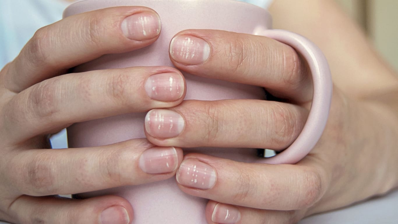 Weiße Flecken auf dem Fingernagel sind meist die Folge eines Lufteinschlusses, der durch kleine Verletzungen des Nagels entsteht.