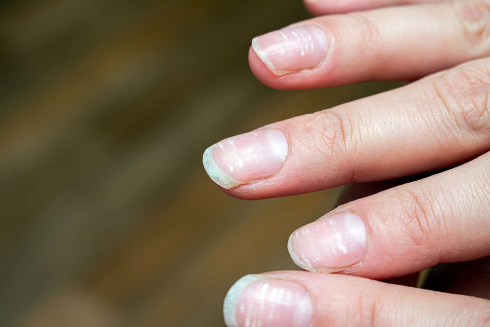 Weiße Flecken auf den Fingernägel sind kleine Lufteinschlüsse.