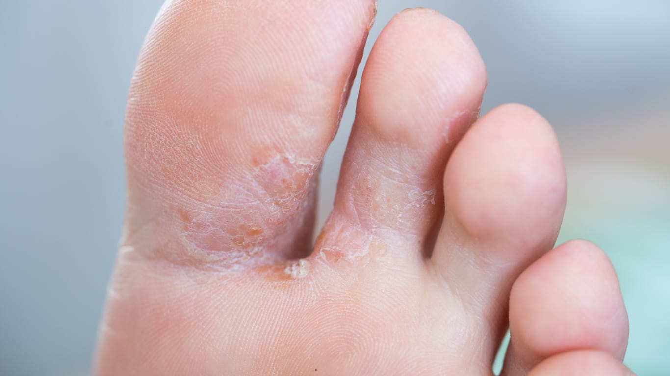 Fuß mit Fußpilz zwischen den Zehen