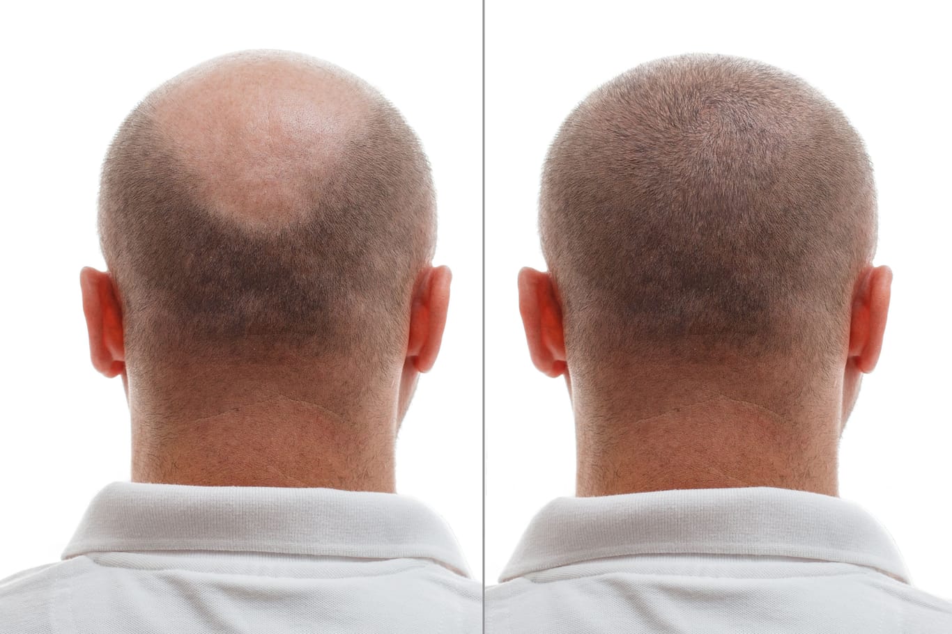 Vor und nach einer Haartransplantation. Immer mehr Männer mit starkem Haarausfall entscheiden sich für den Eingriff.