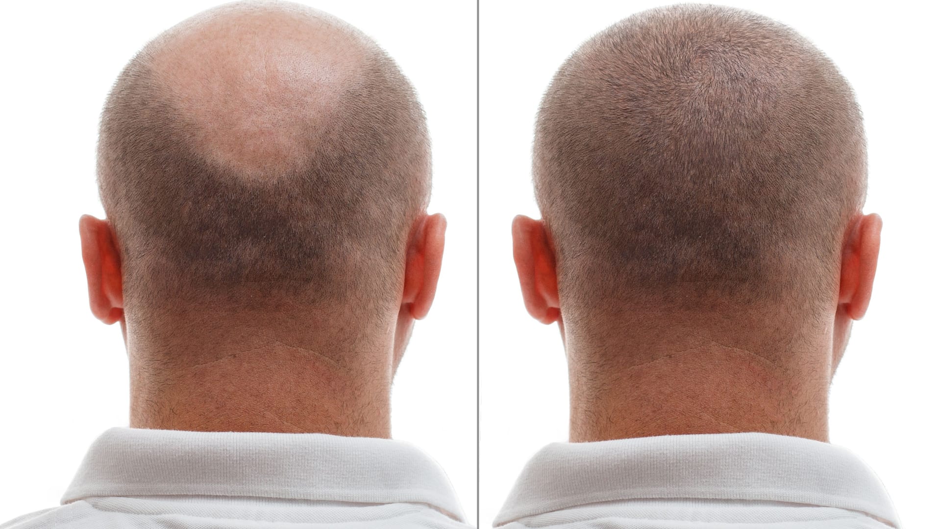 Vor und nach einer Haartransplantation. Immer mehr Männer mit starkem Haarausfall entscheiden sich für den Eingriff.