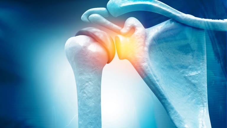 Schulter steif und schmerzt – was steckt hinter der Frozen Shoulder?