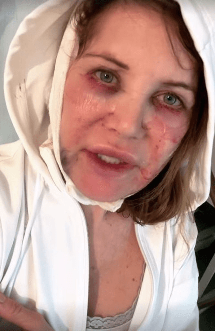 Doreen Dietel zeigt sich nach einem Beauty-Eingriff bei Instagram.