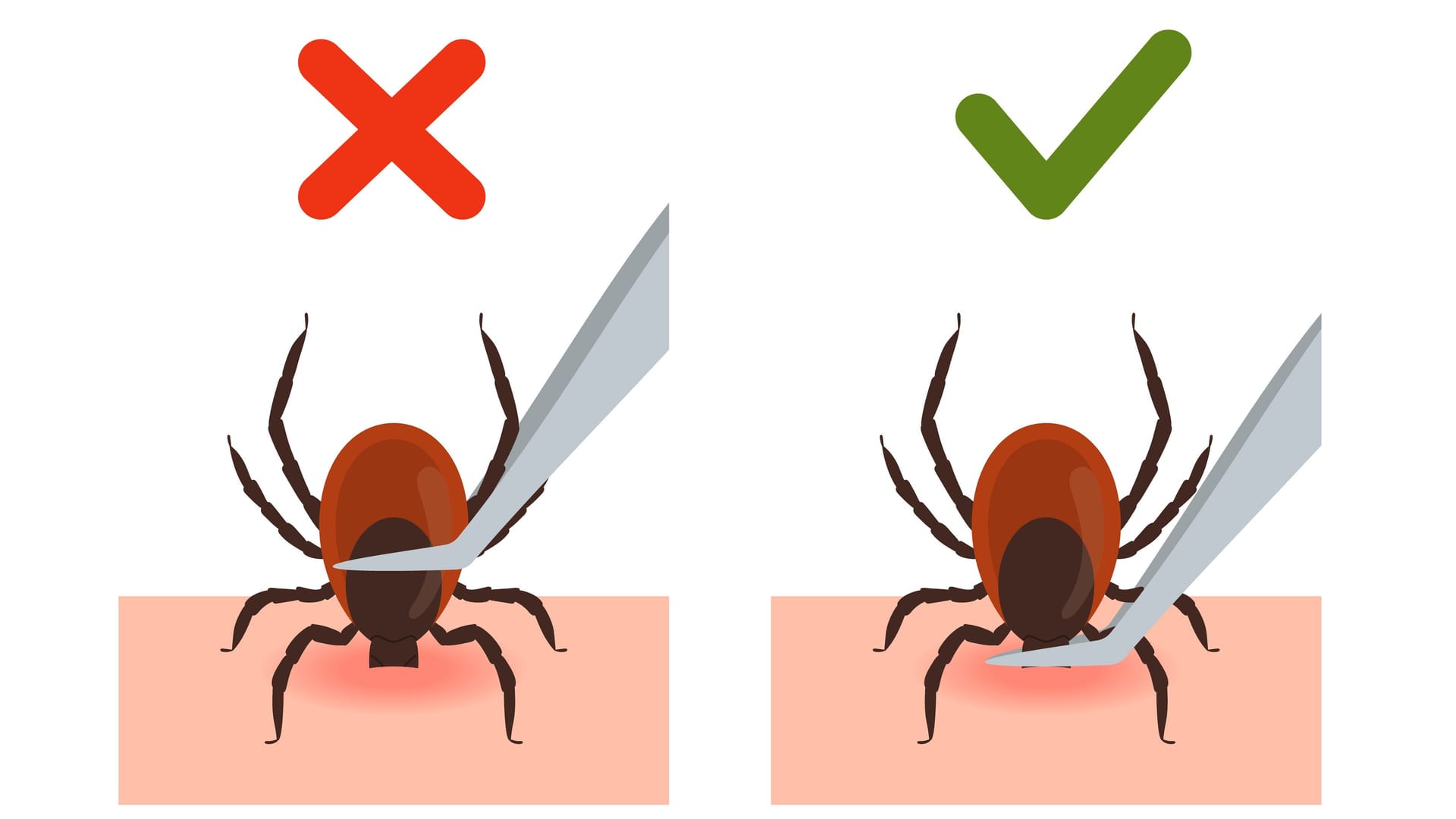 Illustration zur richtigen Handhabung einer Zeckenpinzette