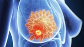 Es gibt verschiedene Arten von Brustkrebs. Zwei häufige Arten sind das "Duktale Karzinom", welches in den Milchgängen entsteht und das "Lobuläre Karzinom", das in einem der Drüsenläppchen seinen Ursprung hat. Beide lassen sich jeweils in "nicht-invasive" (räumlich-begrenzte) und "invasive" Tumore unterteilen. Letztere breiten sich in umgrenzendes Gewebe aus und können Metastasen bilden.