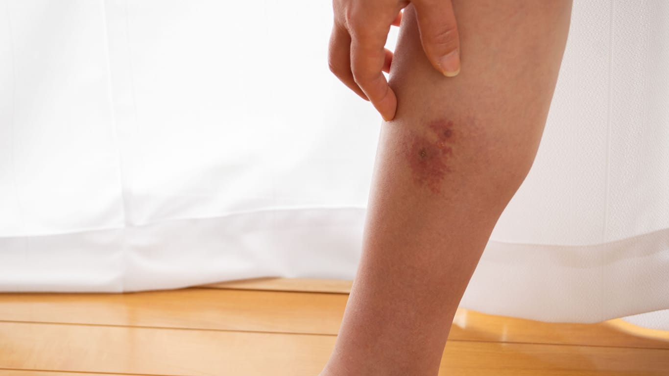 Hautinfektion am Bein